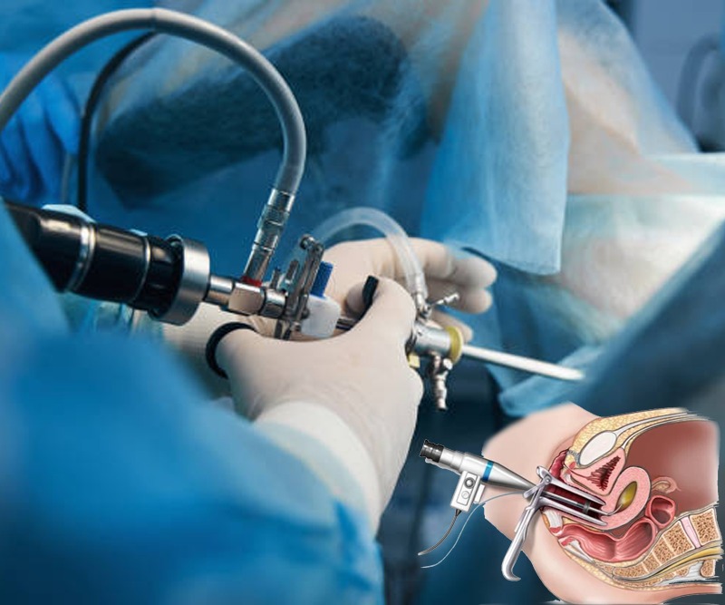 Hysteroscopy Birmingham procedure illustration