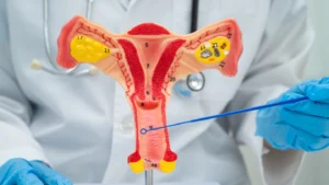 Vaginal prolapse in Birmingham