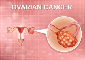 Illustration showing ovarian cancer symptoms with a medical diagram of the female reproductive system and a close-up view of an ovarian tumour.