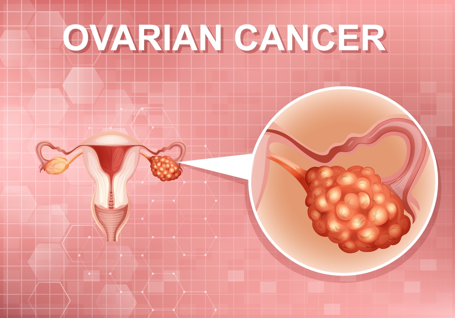 Illustration showing ovarian cancer symptoms with a medical diagram of the female reproductive system and a close-up view of an ovarian tumour.